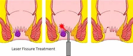 Best Laser Fissure Treatment in Goregaon